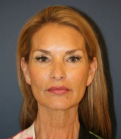 Feel Beautiful - Preventive Face and Neck Lift - Before Photo